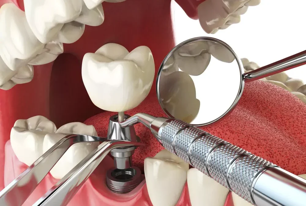 Dental Implant