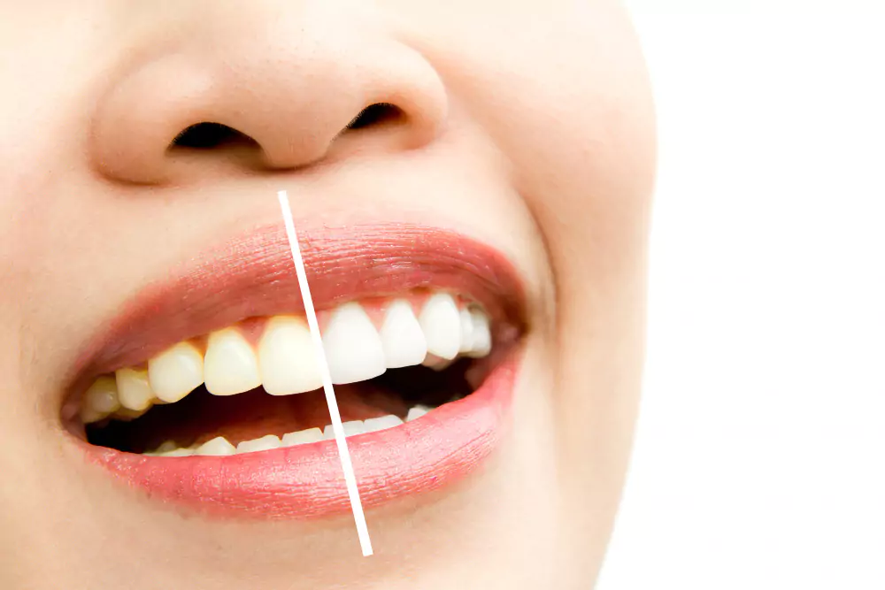 Scaling & Bleaching