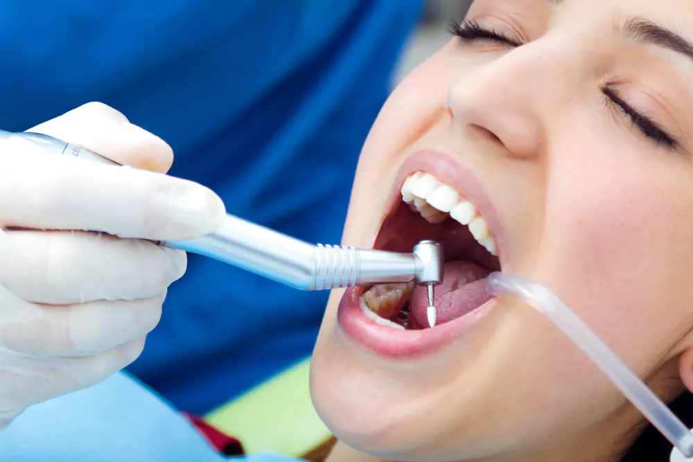 Dental Fillings
