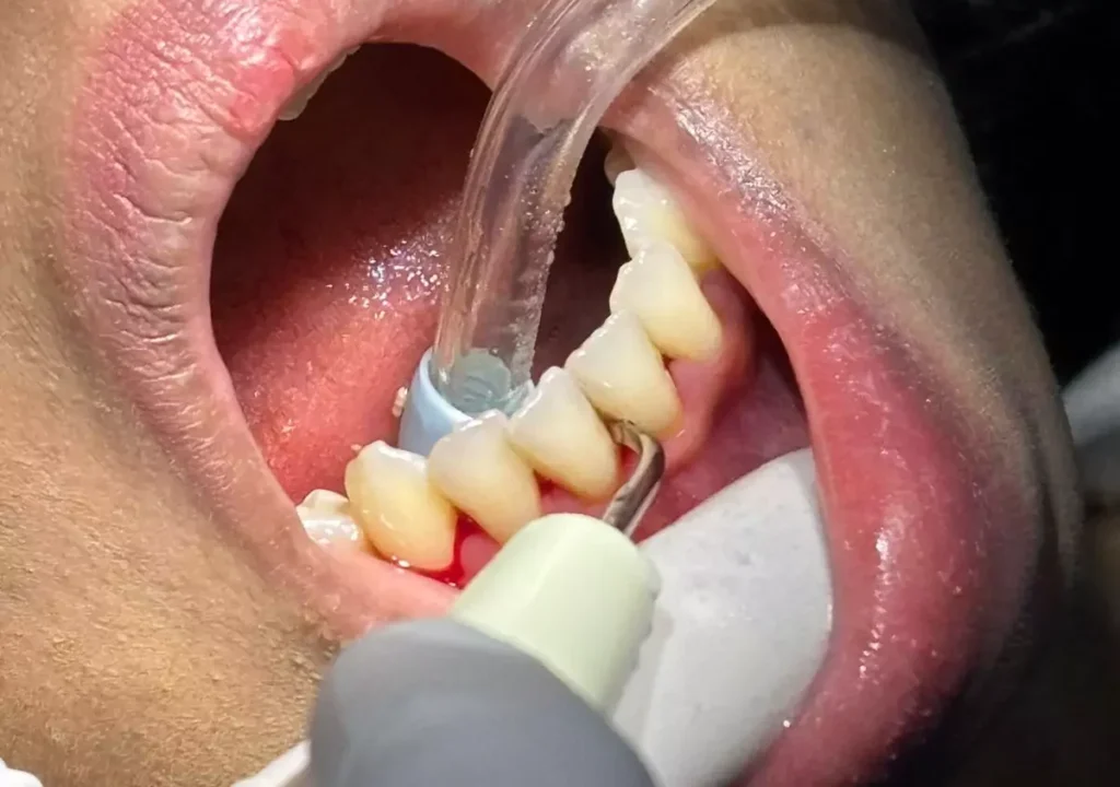 Scaling & Polishing