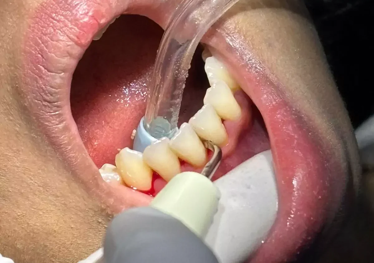 Scaling & Polishing